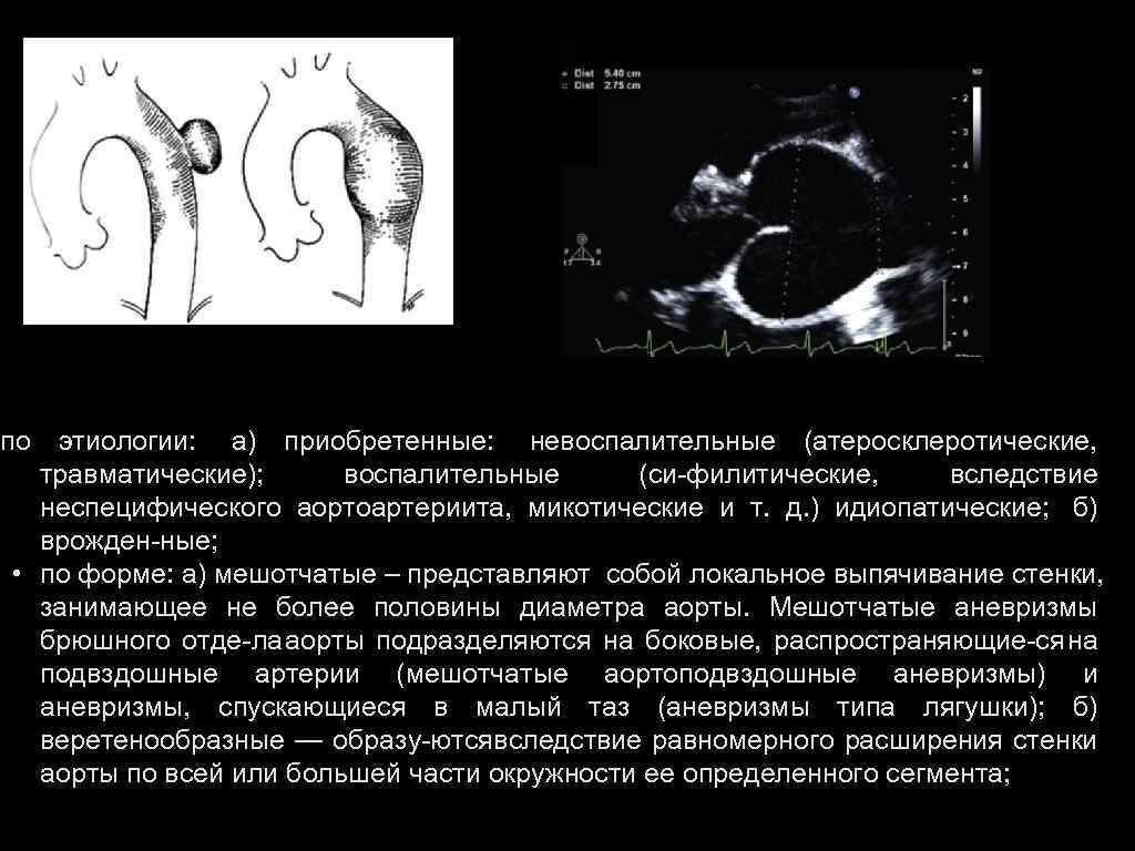 по этиологии: а) приобретенные: невоспалительные (атеросклеротические, травматические); воспалительные (си филитические, вследствие неспецифического аортоартериита, микотические