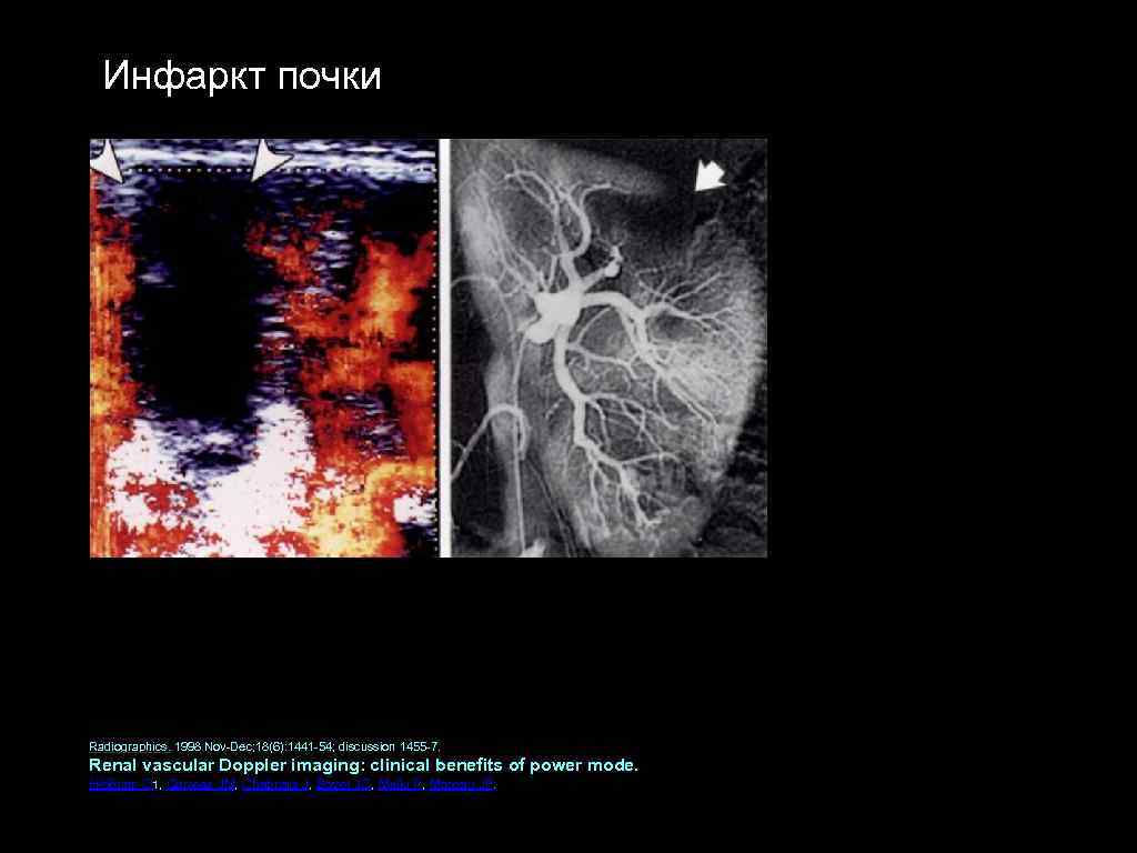 Инфаркт почки Radiographics. 1998 Nov Dec; 18(6): 1441 54; discussion 1455 7. Renal vascular