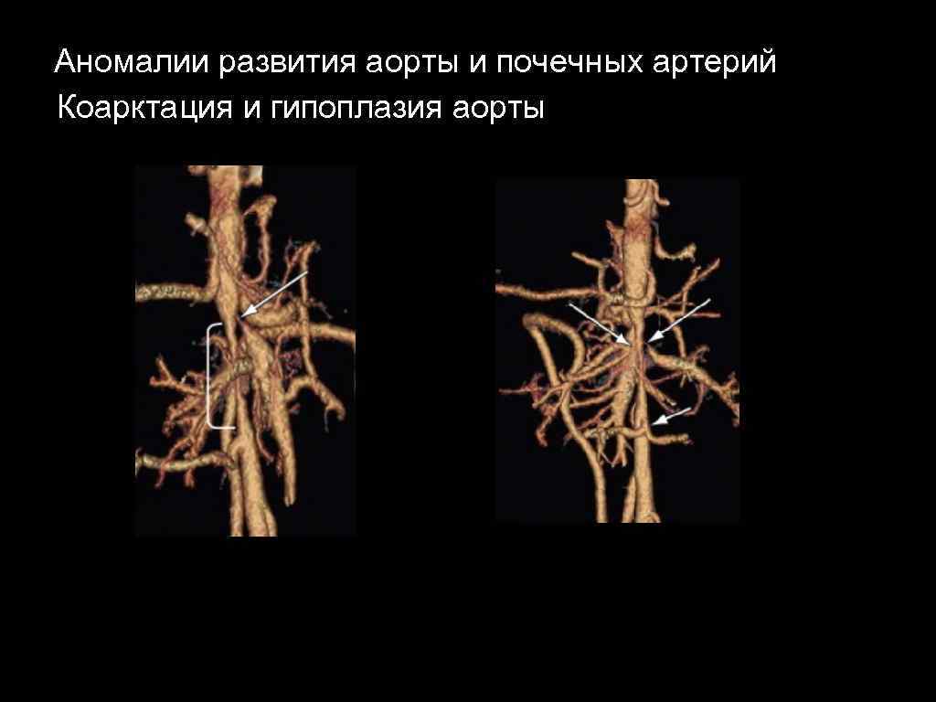 Аномалии развития аорты и почечных артерий Коарктация и гипоплазия аорты 