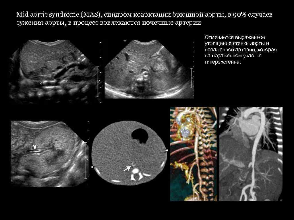 Mid aortic syndrome (MAS), синдром коарктации брюшной аорты, в 90% случаев сужения аорты, в