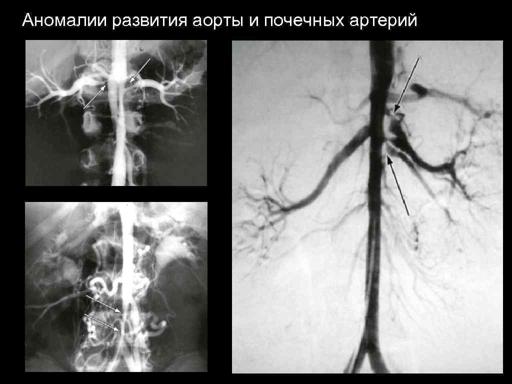 Аномалии развития аорты и почечных артерий 
