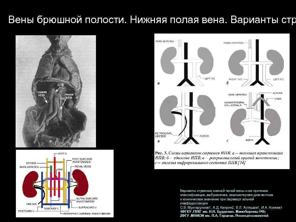 Вены брюшной полости. Нижняя полая вена. Варианты строения нижней полой вены и ее притоков: