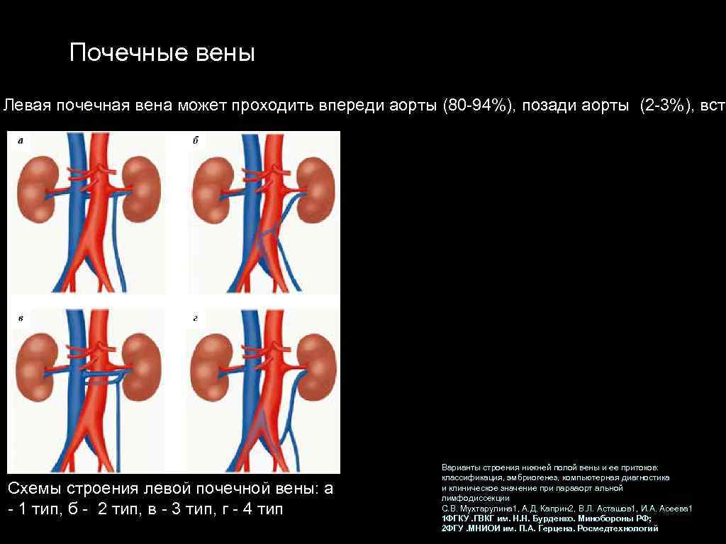 Почечные вены Левая почечная вена может проходить впереди аорты (80 94%), позади аорты (2