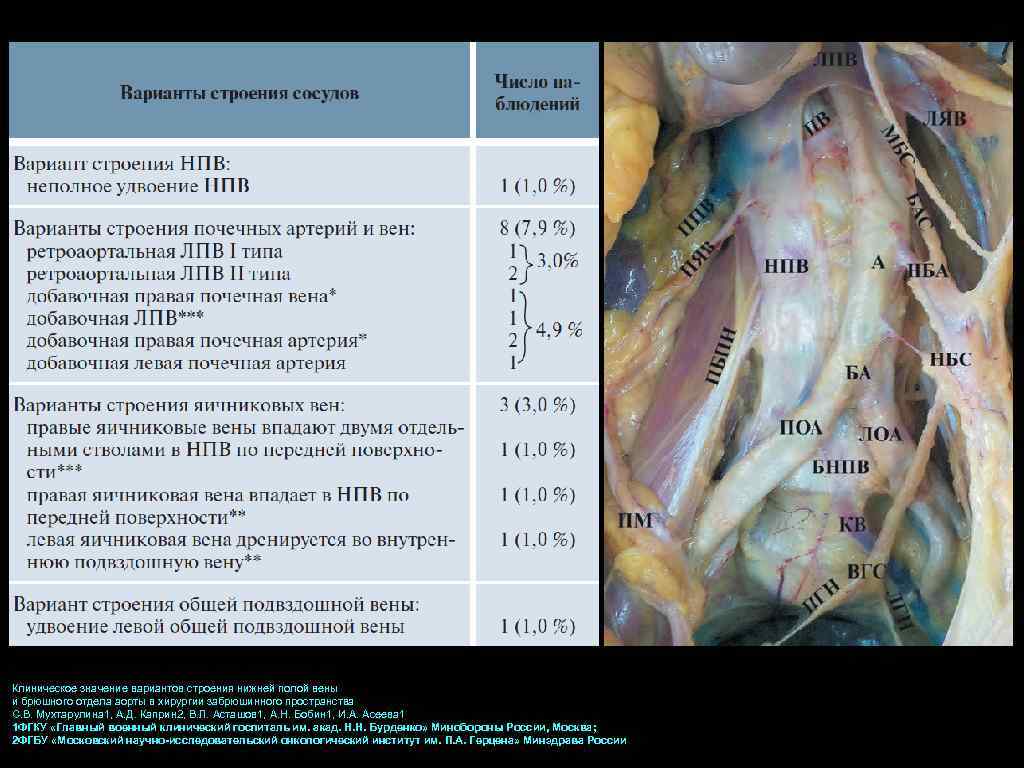 Клиническое значение вариантов строения нижней полой вены и брюшного отдела аорты в хирургии забрюшинного