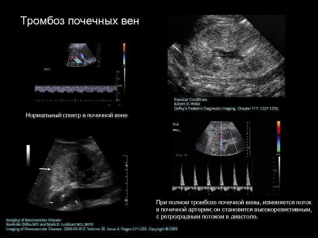 Тромбоз почечных вен Vascular Conditions Robert G. Wells Caffey's Pediatric Diagnostic Imaging, Chapter 117,