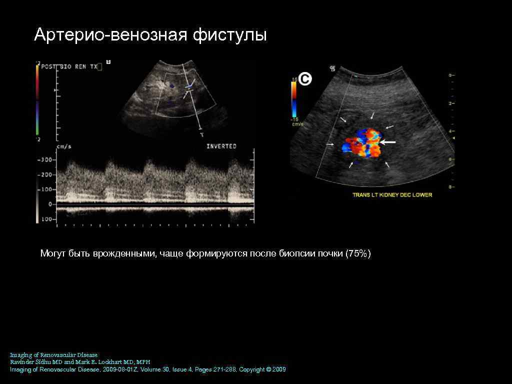 Артерио венозная фистулы Могут быть врожденными, чаще формируются после биопсии почки (75%) Imaging of