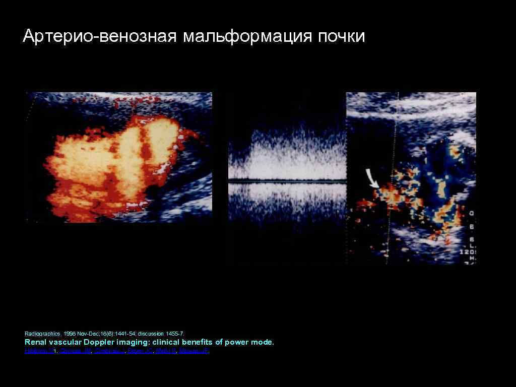 Артерио венозная мальформация почки Radiographics. 1998 Nov Dec; 18(6): 1441 54; discussion 1455 7.