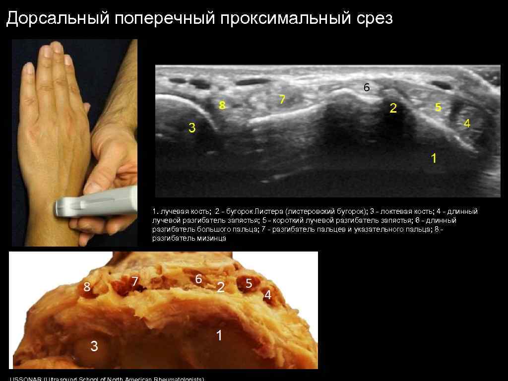 Дорсальный поперечный проксимальный срез 1. лучевая кость; 2 - бугорок Листера (листеровский бугорок); 3