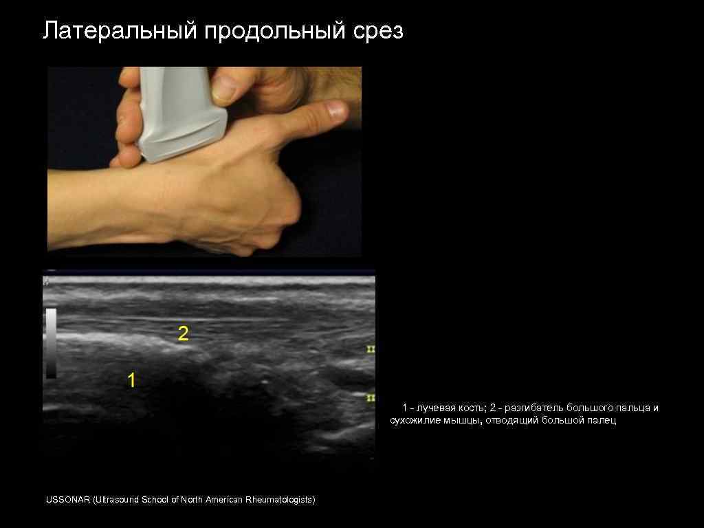 Узи кисти. Протокол УЗИ сухожилий кисти. Ультразвуковое исследование лучезапястного сустава. УЗИ суставов кистей рук.
