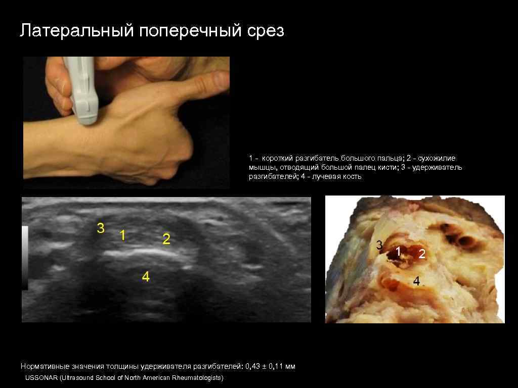 Латеральный поперечный срез 1 - короткий разгибатель большого пальца; 2 - сухожилие мышцы, отводящий