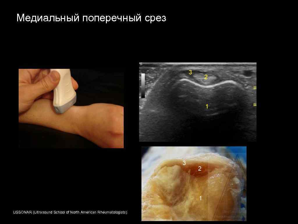 Медиальный поперечный срез USSONAR (Ultrasound School of North American Rheumatologists) 