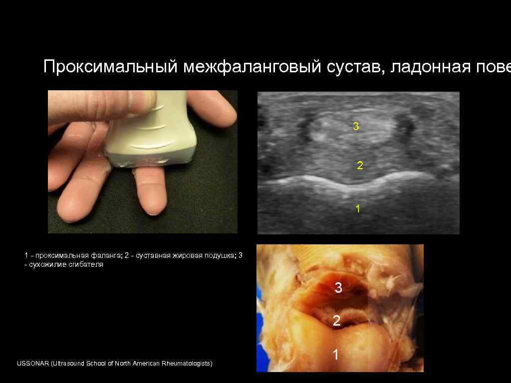 Проксимальный межфаланговый сустав, ладонная пове 1 - проксимальная фаланга; 2 - суставная жировая подушка;