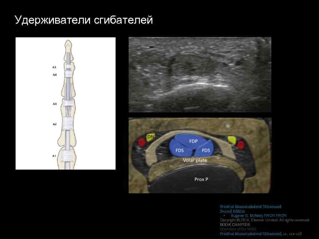 Удерживатели сгибателей Practical Musculoskeletal Ultrasound Second Edition • Eugene G. Mc. Nally FRCR FRCPI