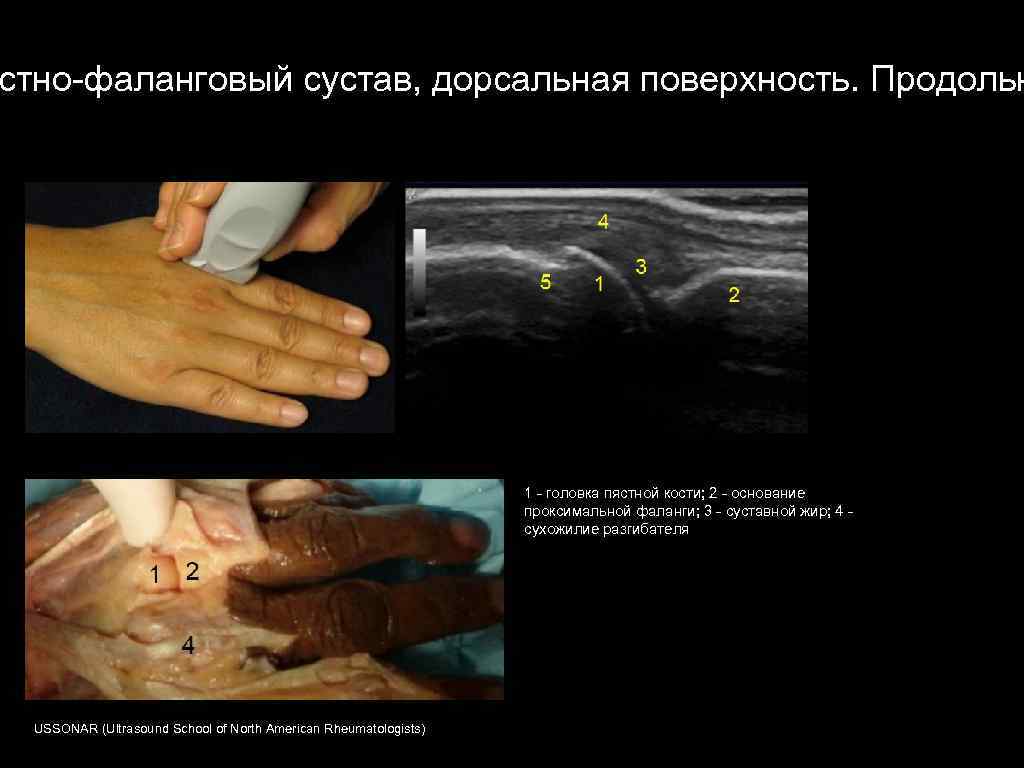 стно-фаланговый сустав, дорсальная поверхность. Продольн 1 - головка пястной кости; 2 - основание проксимальной