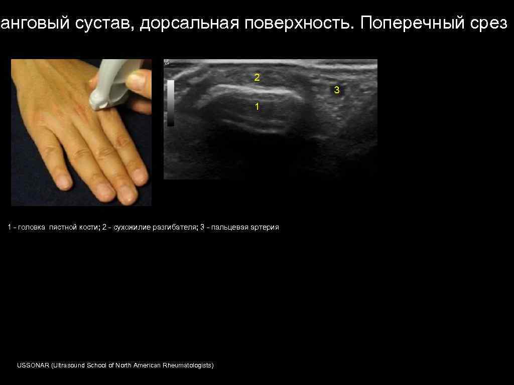 Узи кисти. УЗИ пястно фалангового сустава. УЗИ мягких тканей кисти руки. УЗИ тендовагинит разгибателей кисти.