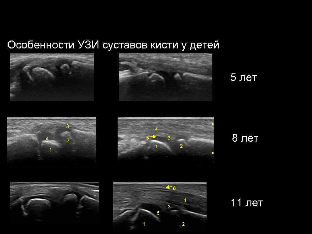 Узи костей детям. Тендовагинит лучезапястного сустава на УЗИ. УЗИ суставов кисти протокол.