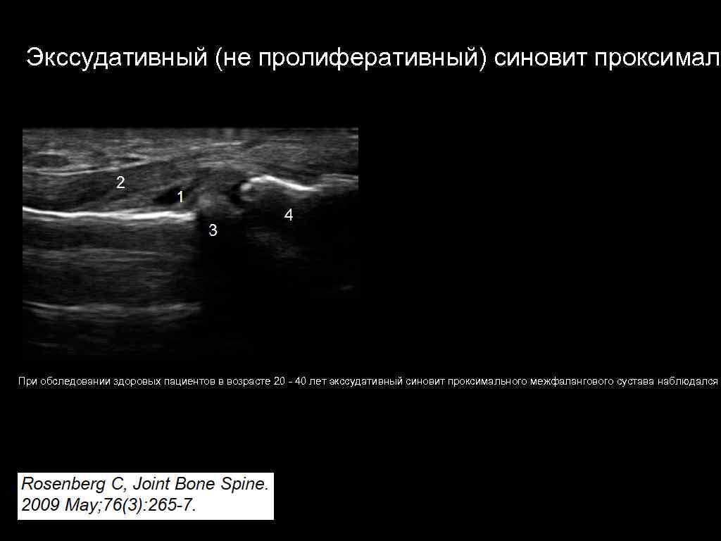 Узи кисти. Пролиферативный синовит. Пролиферативный синовит мрт. Пролиферативный синовит коленного сустава. УЗИ признаки синовита.