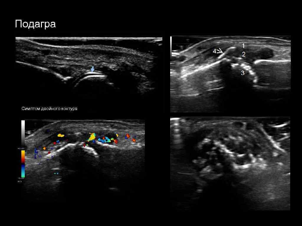 Узи кисти. Двойной контур на УЗИ подагра. Ультразвуковое исследование суставов при подагре. УЗИ суставов при подагре.