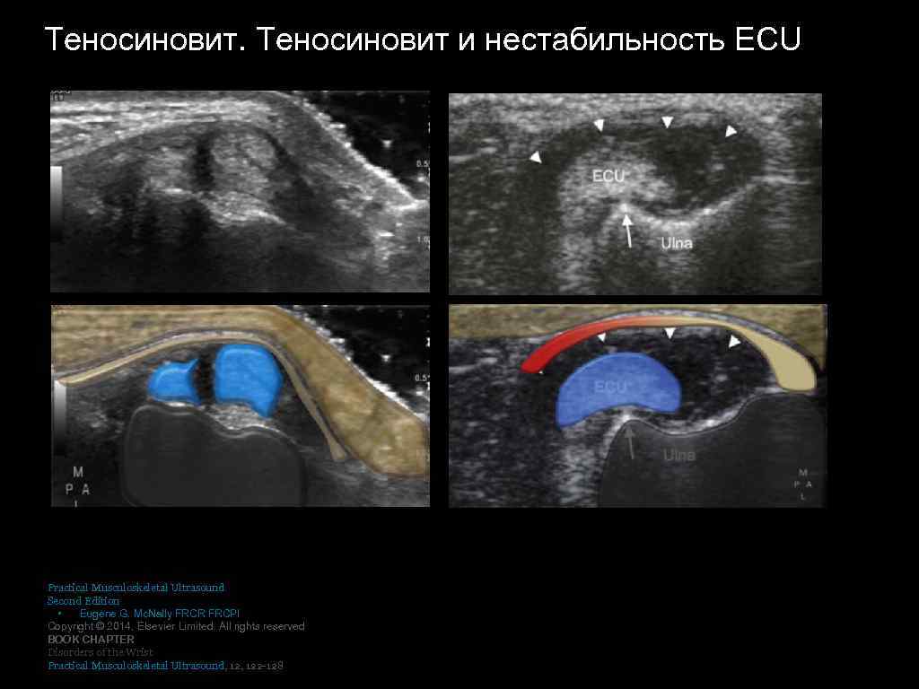 Теносиновит и нестабильность ECU Practical Musculoskeletal Ultrasound Second Edition • Eugene G. Mc. Nally