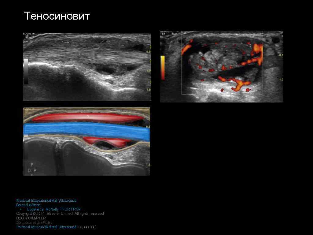 Теносиновит Practical Musculoskeletal Ultrasound Second Edition • Eugene G. Mc. Nally FRCR FRCPI Copyright