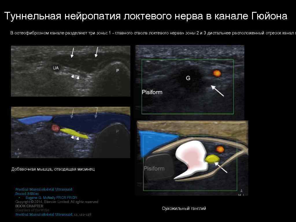 Туннельная нейропатия локтевого нерва в канале Гюйона В остеофиброзном канале разделяют три зоны: 1