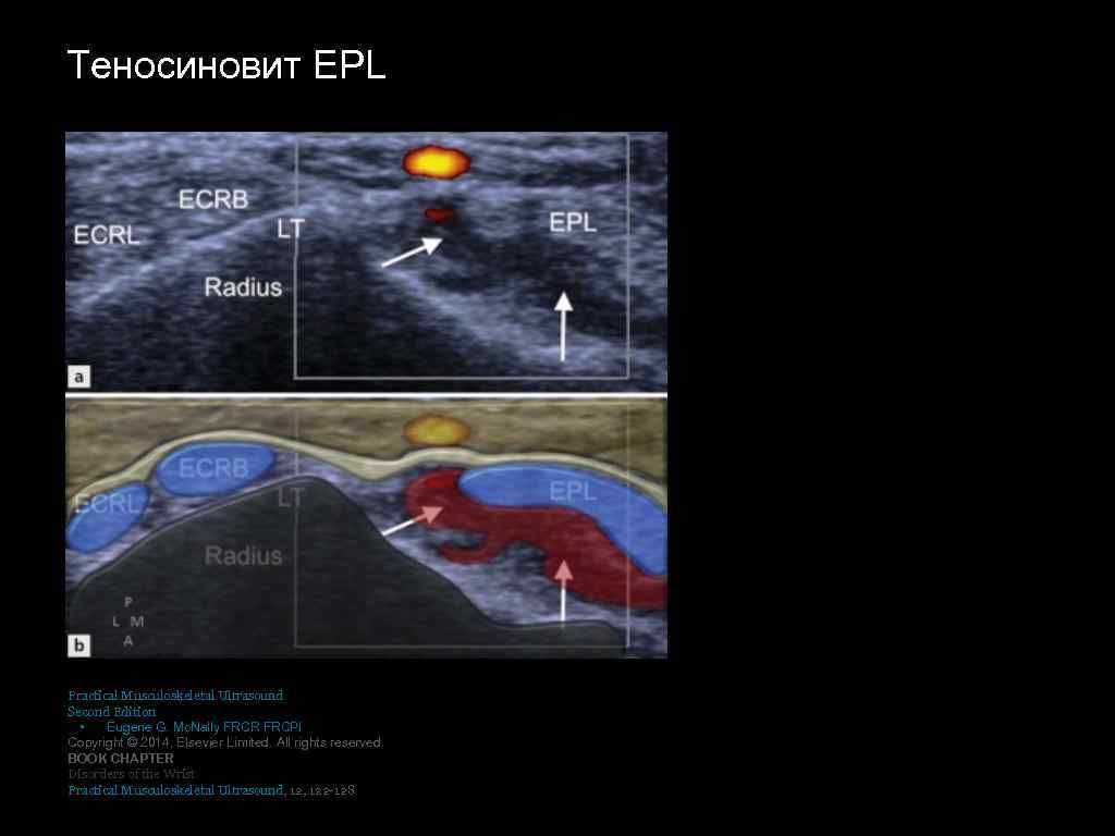 Теносиновит EPL Practical Musculoskeletal Ultrasound Second Edition • Eugene G. Mc. Nally FRCR FRCPI