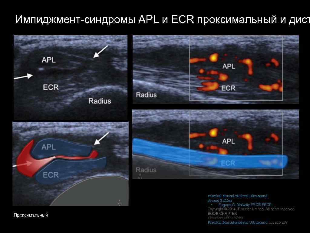 Узи кисти. Субакромиальный импинджмент-синдром на УЗИ. Импиджмент синдром правого плечевого сустава на УЗИ. Импичмент синдром плечевого сустава на УЗИ.