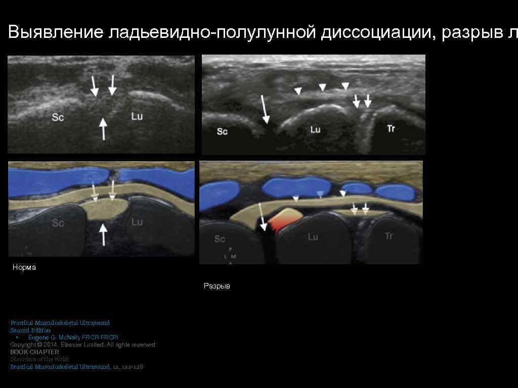 Выявление ладьевидно-полулунной диссоциации, разрыв л Норма Разрыв Practical Musculoskeletal Ultrasound Second Edition • Eugene