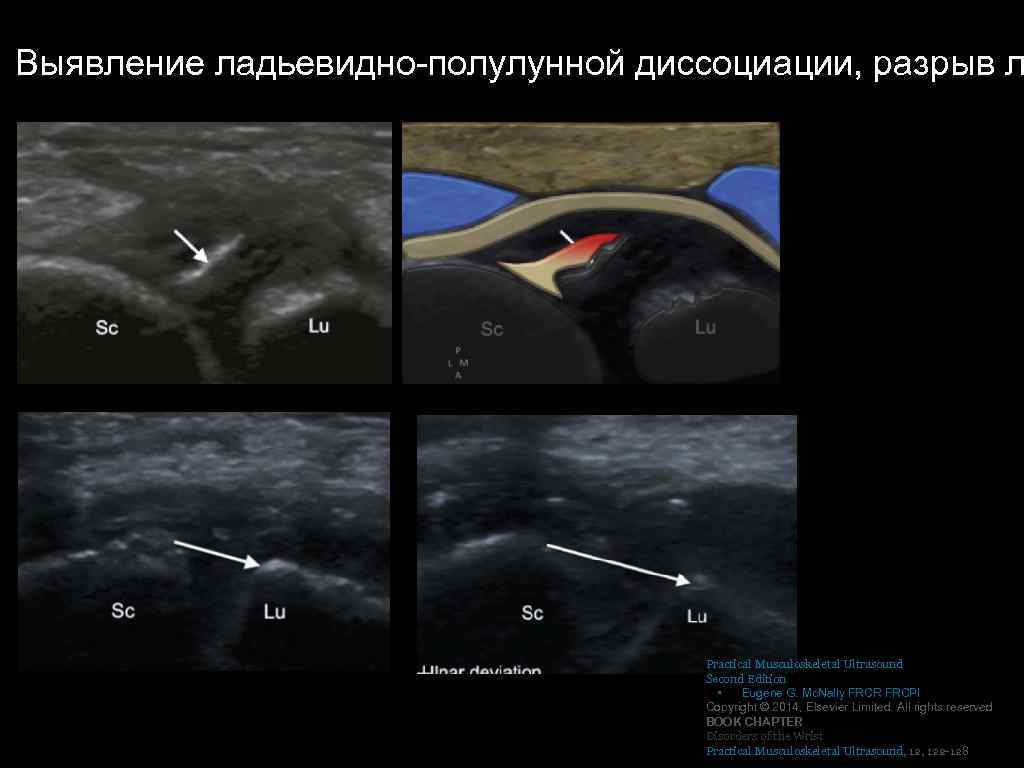 Выявление ладьевидно-полулунной диссоциации, разрыв л Practical Musculoskeletal Ultrasound Second Edition • Eugene G. Mc.