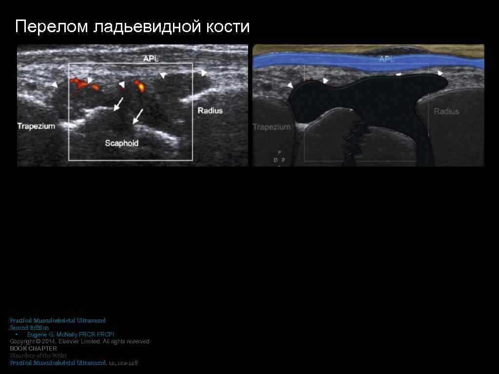 Перелом ладьевидной кости Practical Musculoskeletal Ultrasound Second Edition • Eugene G. Mc. Nally FRCR