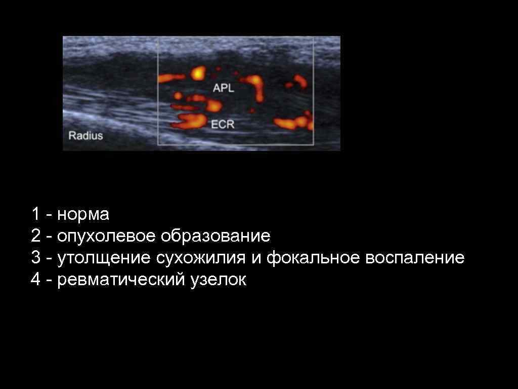 1 - норма 2 - опухолевое образование 3 - утолщение сухожилия и фокальное воспаление