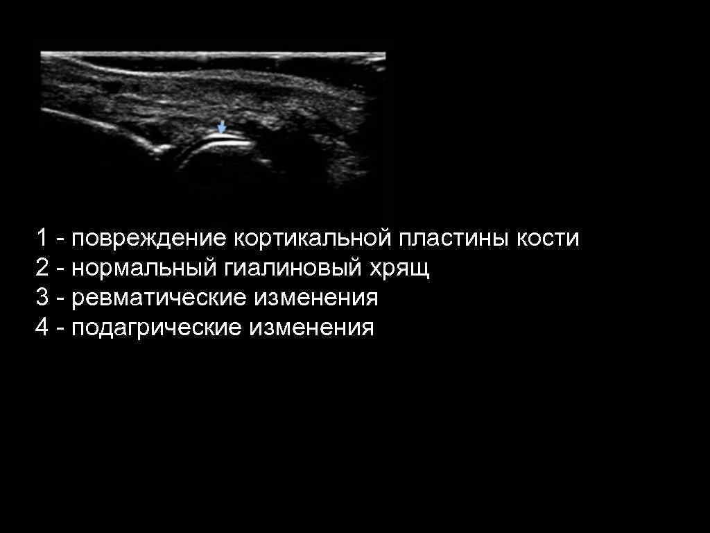 1 - повреждение кортикальной пластины кости 2 - нормальный гиалиновый хрящ 3 - ревматические