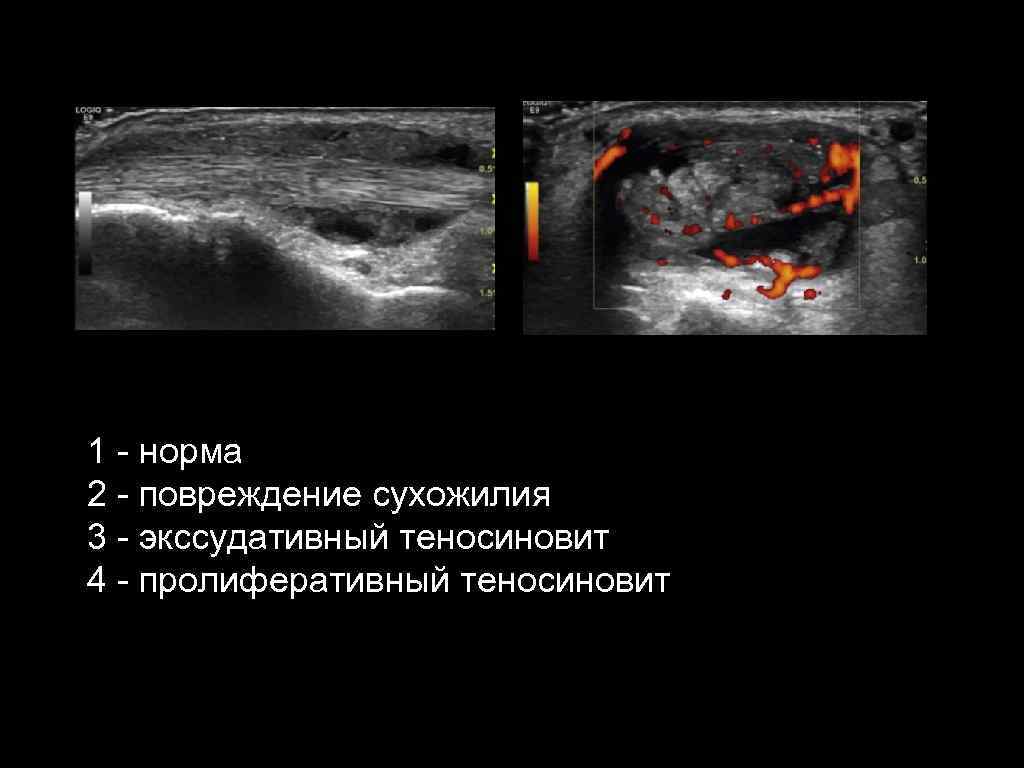 1 - норма 2 - повреждение сухожилия 3 - экссудативный теносиновит 4 - пролиферативный