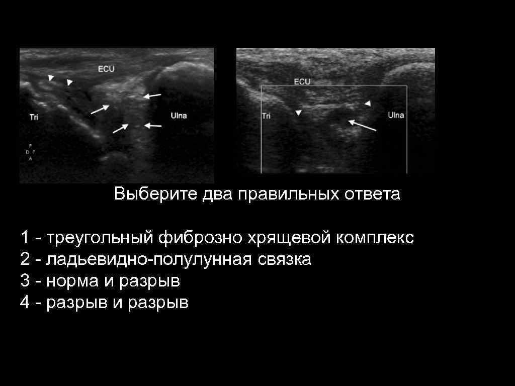 Выберите два правильных ответа 1 - треугольный фиброзно хрящевой комплекс 2 - ладьевидно-полулунная связка