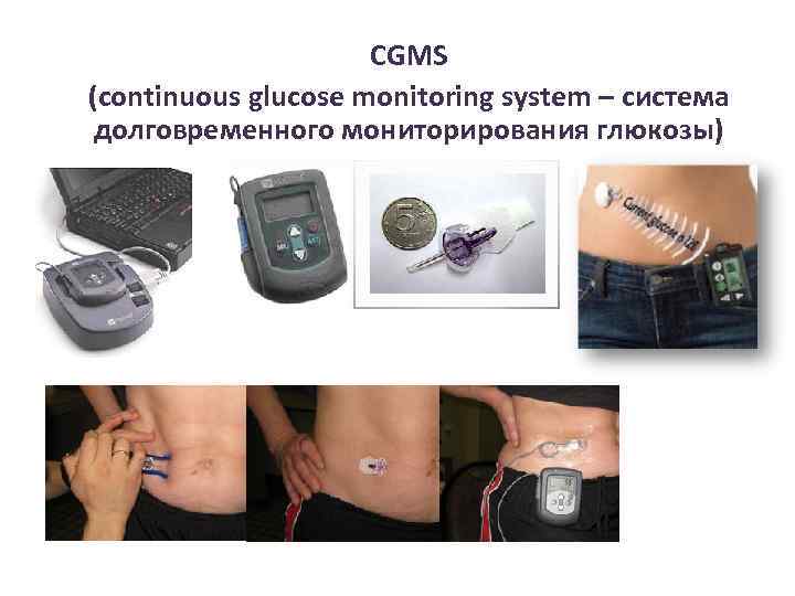 CGMS (continuous glucose monitoring system – система долговременного мониторирования глюкозы) 