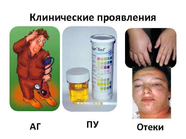 Клинические проявления АГ ПУ Отеки 