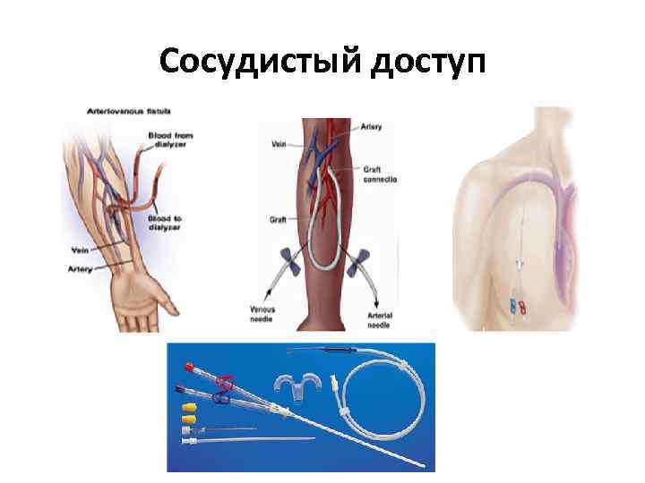 Сосудистый доступ 