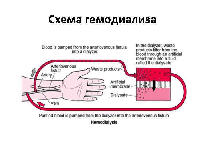 Принцип работы аппарата искусственная почка рисунок