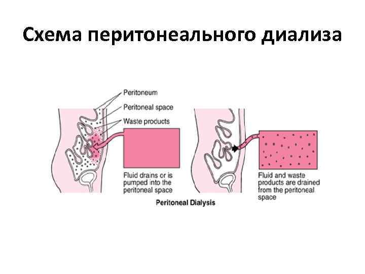 Перитонеальный диализ схема