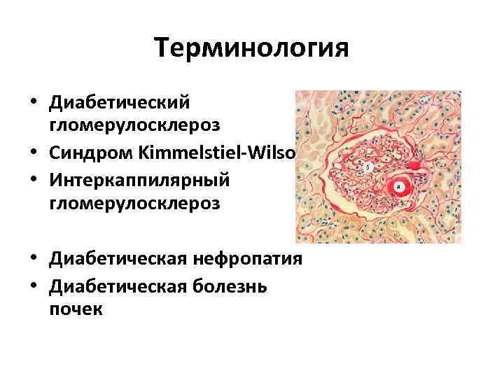 Терминология • Диабетический гломерулосклероз • Синдром Kimmelstiel-Wilson • Интеркаппилярный гломерулосклероз • Диабетическая нефропатия •