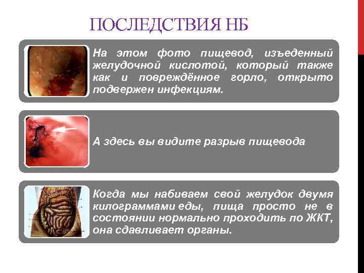 ПОСЛЕДСТВИЯ НБ На этом фото пищевод, изъеденный желудочной кислотой, который также как и повреждённое
