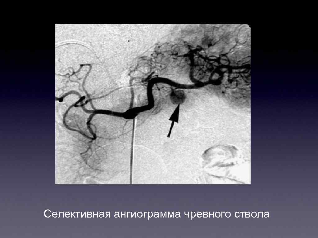 Селективная ангиограмма чревного ствола 