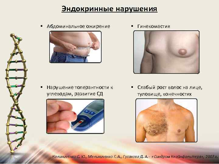 Эндокринные нарушения § Абдоминальное ожирение § Гинекомастия § Нарушение толерантности к углеводам, развитие СД