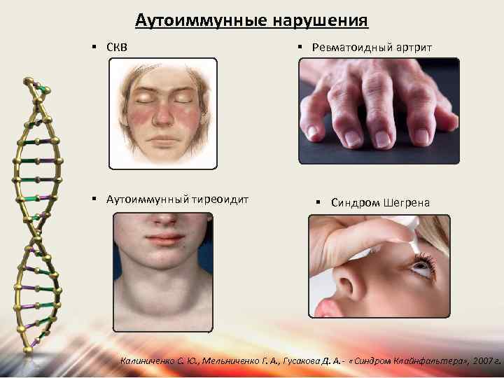 Аутоиммунные нарушения § СКВ § Аутоиммунный тиреоидит § Ревматоидный артрит § Синдром Шегрена Калиниченко