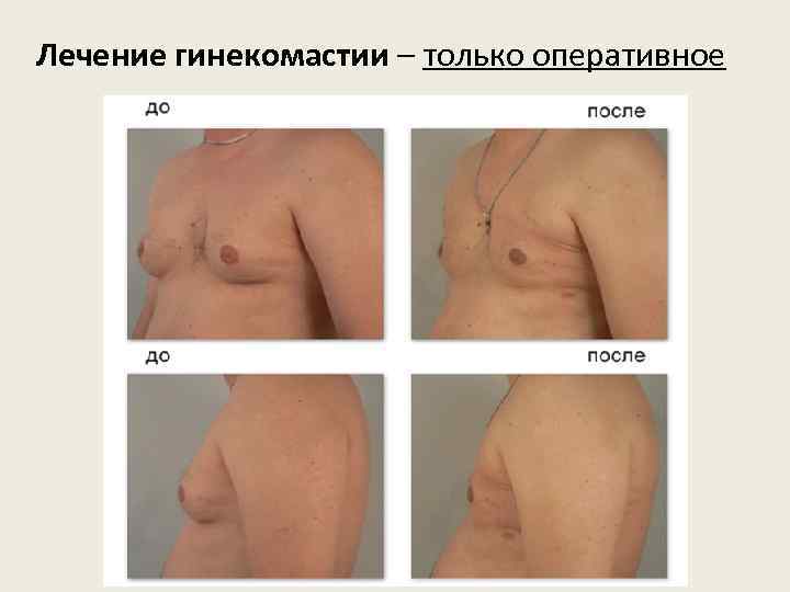 Лечение гинекомастии – только оперативное 