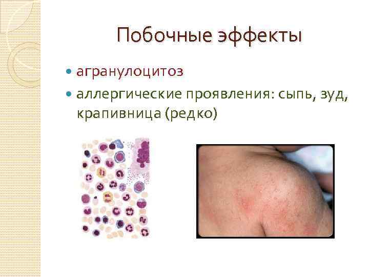 Побочные эффекты агранулоцитоз аллергические проявления: сыпь, зуд, крапивница (редко) 