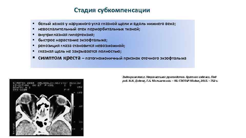 Стадия субкомпенсации § § § белый хемоз у наружного угла глазной щели и вдоль