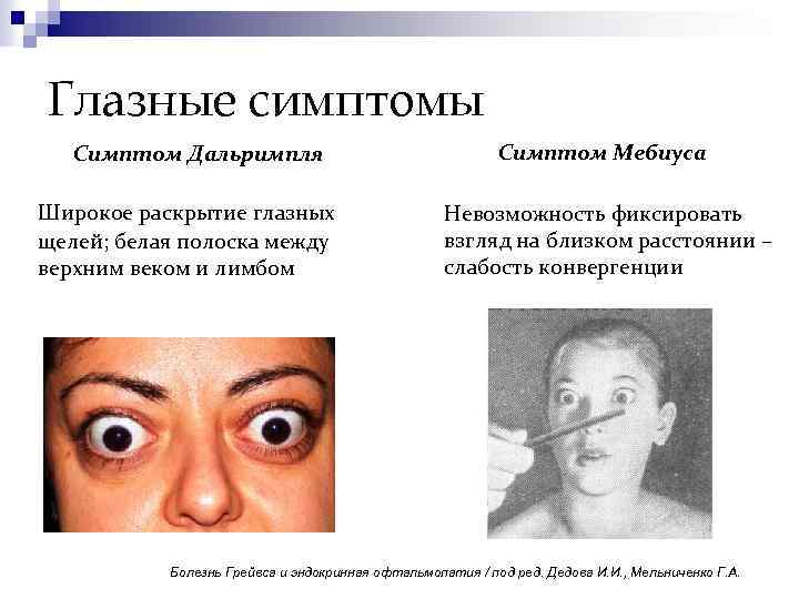 Глазные симптомы Симптом Дальримпля Широкое раскрытие глазных щелей; белая полоска между верхним веком и