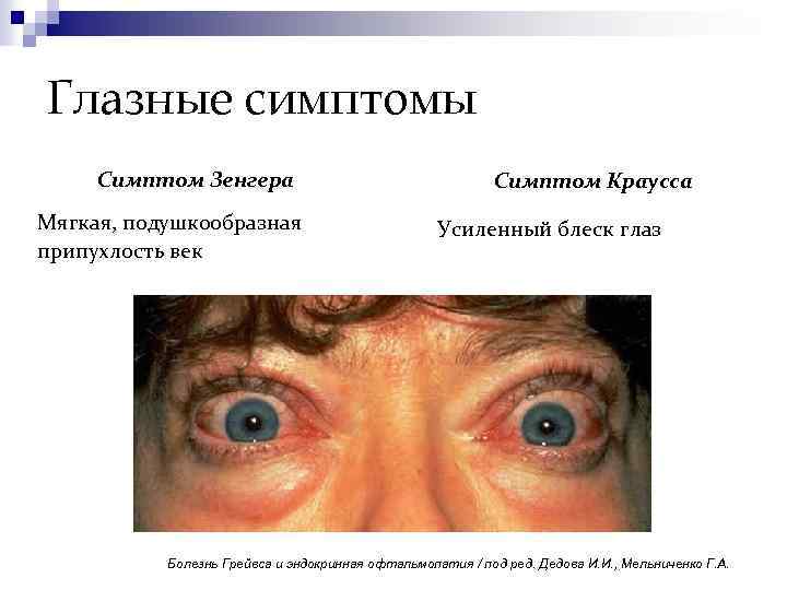 Глазные симптомы Симптом Зенгера Мягкая, подушкообразная припухлость век Симптом Краусса Усиленный блеск глаз Болезнь
