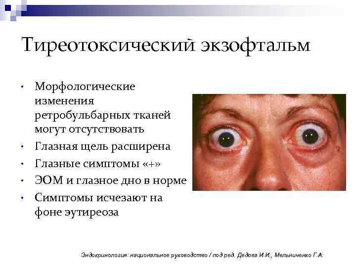Тиреотоксический экзофтальм • • • Морфологические изменения ретробульбарных тканей могут отсутствовать Глазная щель расширена